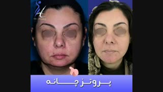 قبل و بعد از پروتز چانه
