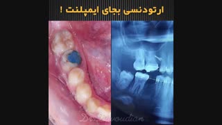 ارتودنسی به جای ایمپلنت | دکتر داودیان