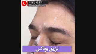 بوتاکس پیشانی کشیدن دندان